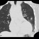 Chest tube, pleural drain: CT - Computed tomography
